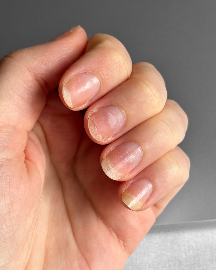 Damaged nails being treated